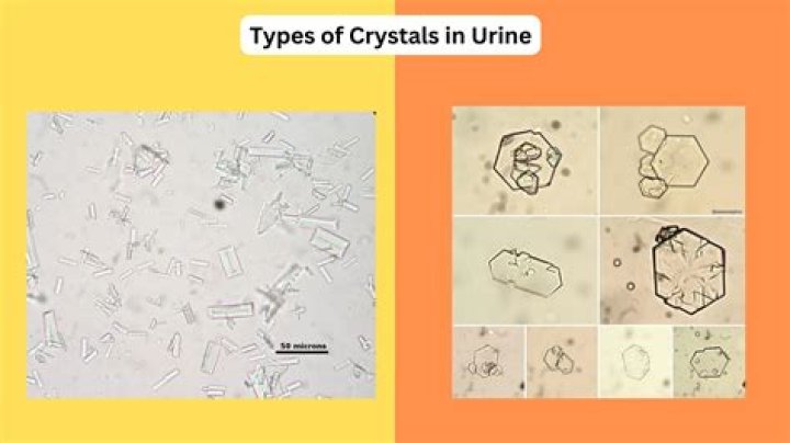 Can you see uric acid crystals in urine?