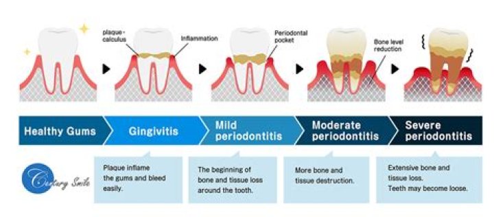 Can you stop periodontitis at home?