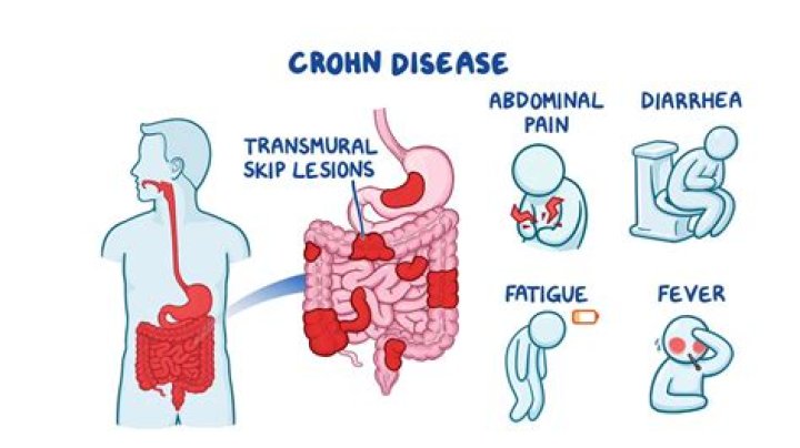 Can you suddenly develop Crohn's disease?