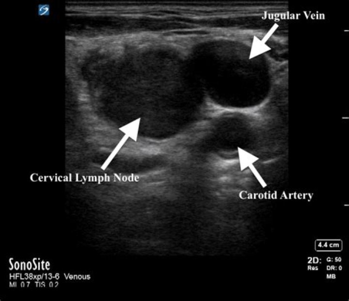 Can you tell if a lymph node is cancerous by ultrasound?