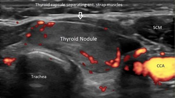 Can you tell if a thyroid nodule is cancerous from an ultrasound?