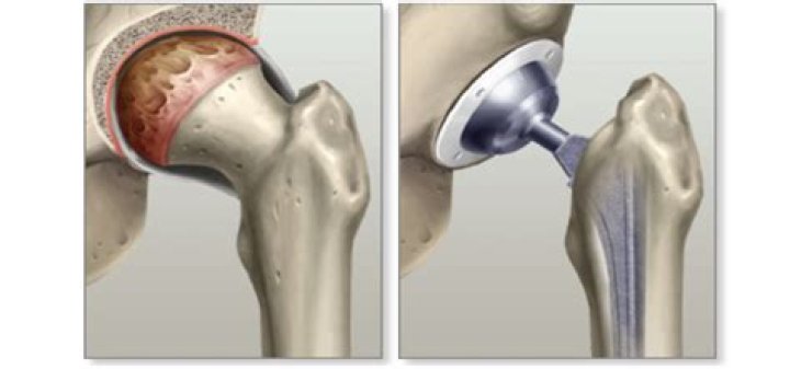 Can you wait too long to have hip replacement?