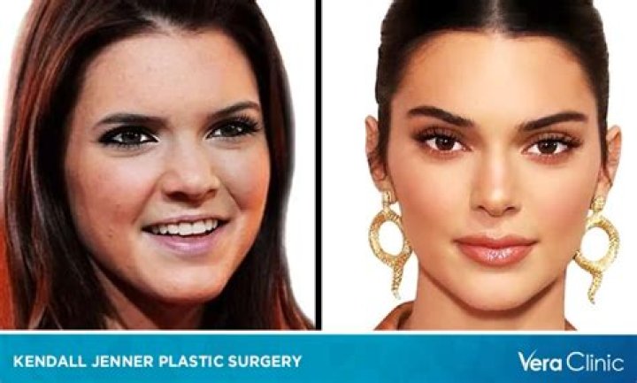 Did Kendall Jenner have braces?