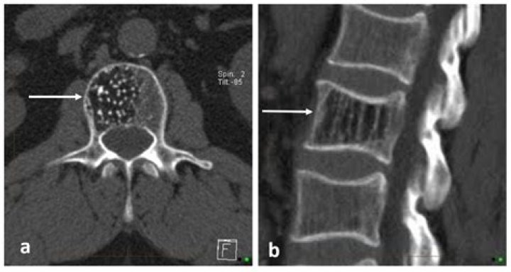 Do benign spinal tumors cause pain?