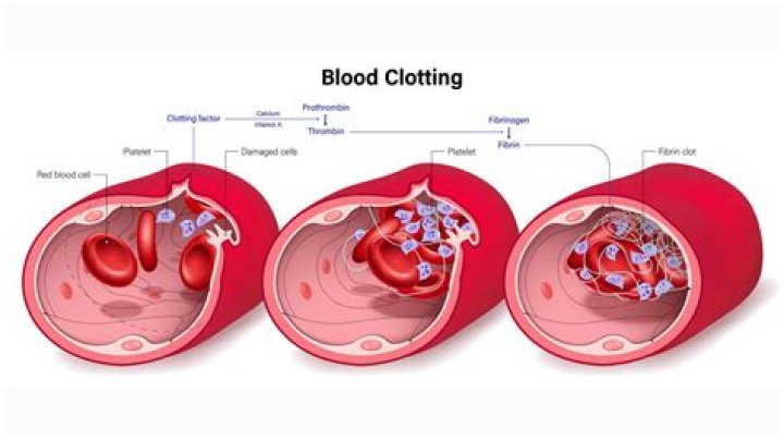 Do blood clots go away with blood thinners?