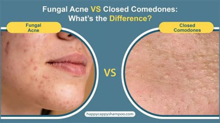 Do I have fungal acne or closed comedones?