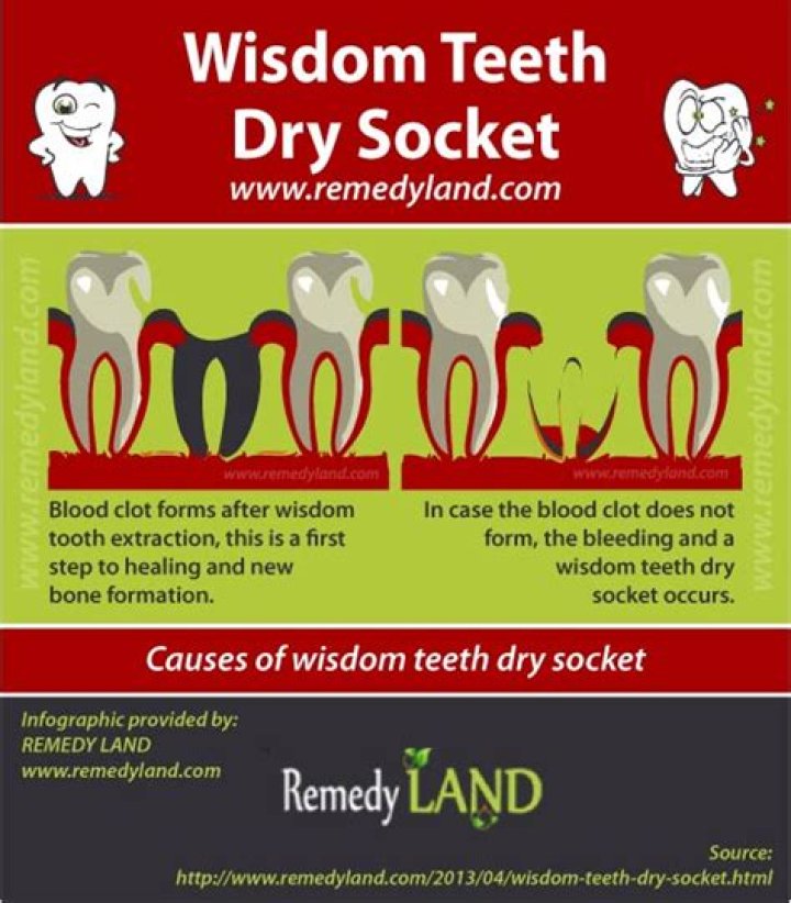 Do I need antibiotics for dry socket?