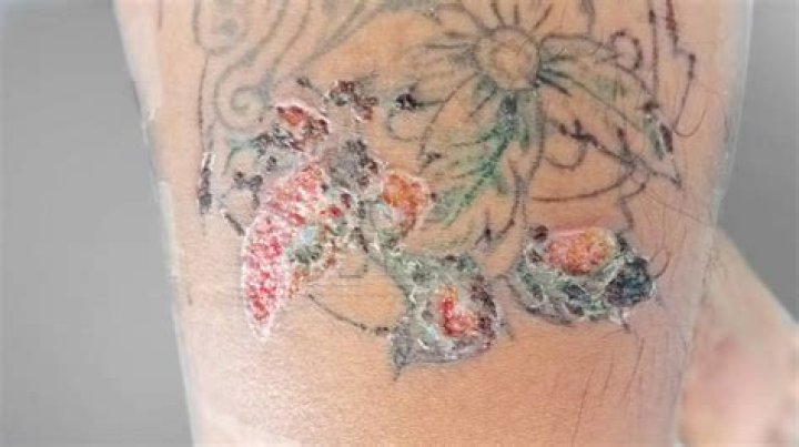 Do lip tattoos get infected easily?