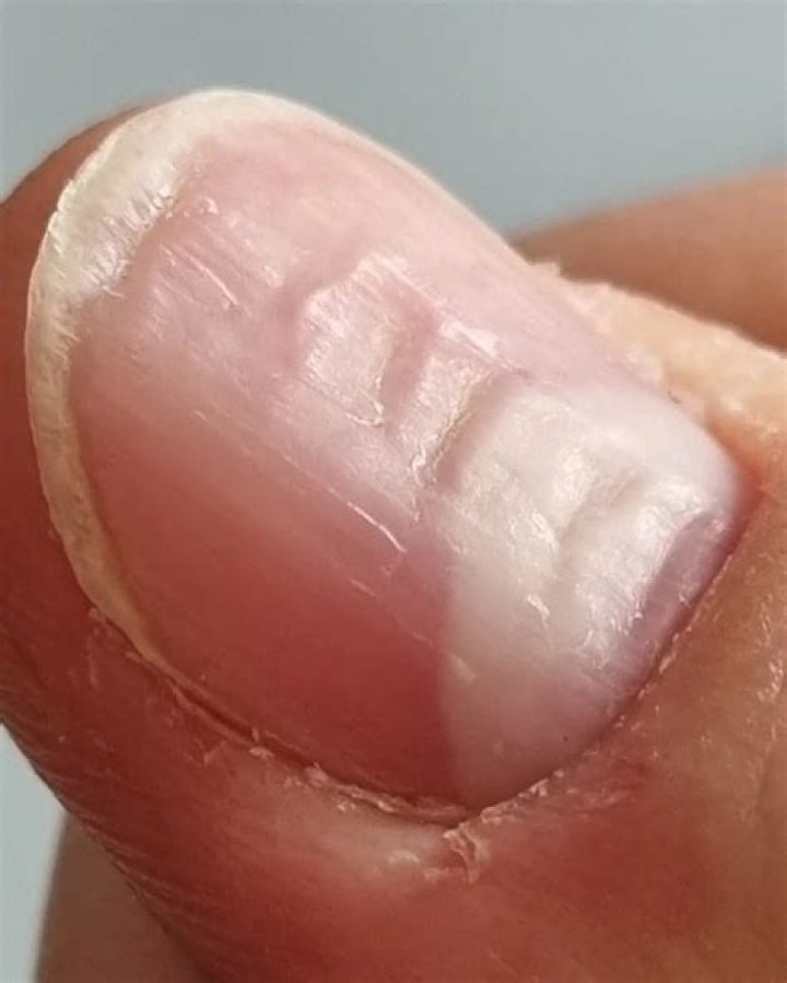 Do long nails cause acne?