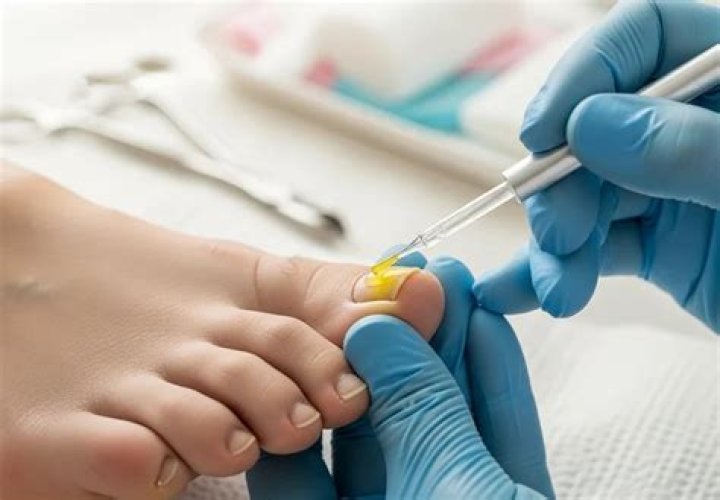 Do podiatrists treat toenail fungus?