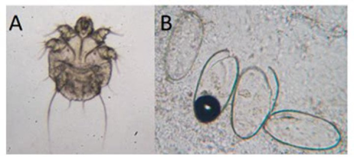 Do scabies lay eggs in hair?