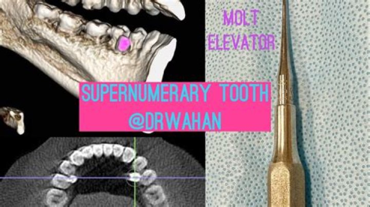 Do supernumerary teeth need to be removed?