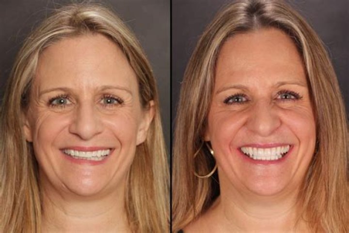 Do teeth wear down with age?
