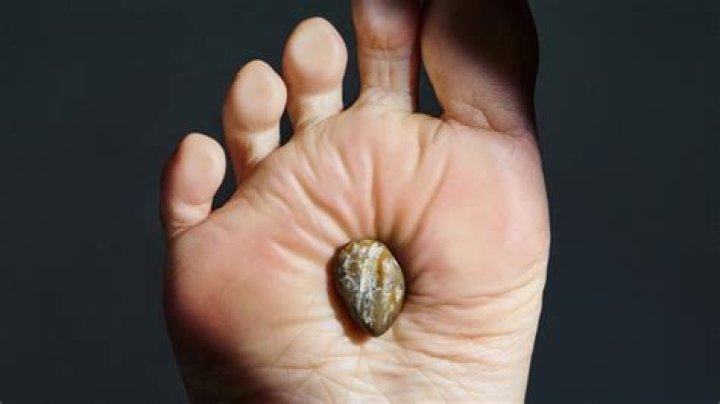 Do warts leave a hole?