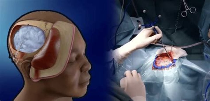 Do you go to ICU after craniotomy?