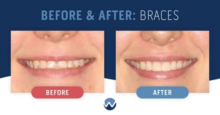 Do your lips change after braces?