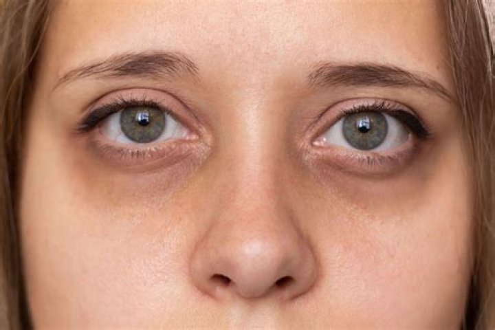 Does alcohol cause dark circles under eyes?
