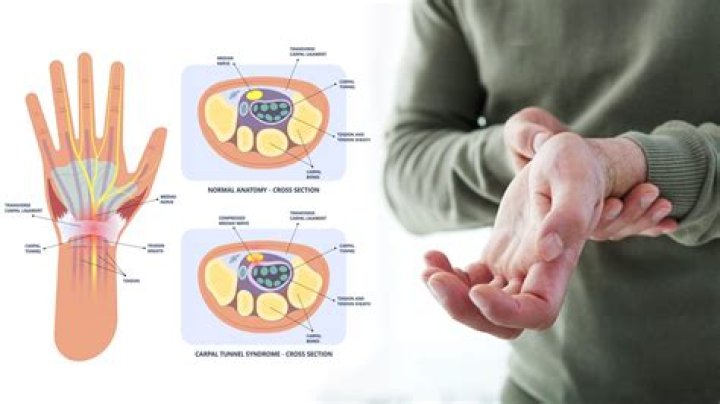 Does carpal tunnel make your whole arm hurt?
