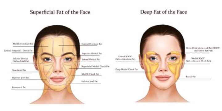 Does cheek fat go away?
