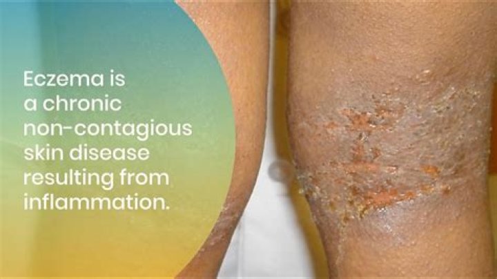Does chocolate affect eczema?