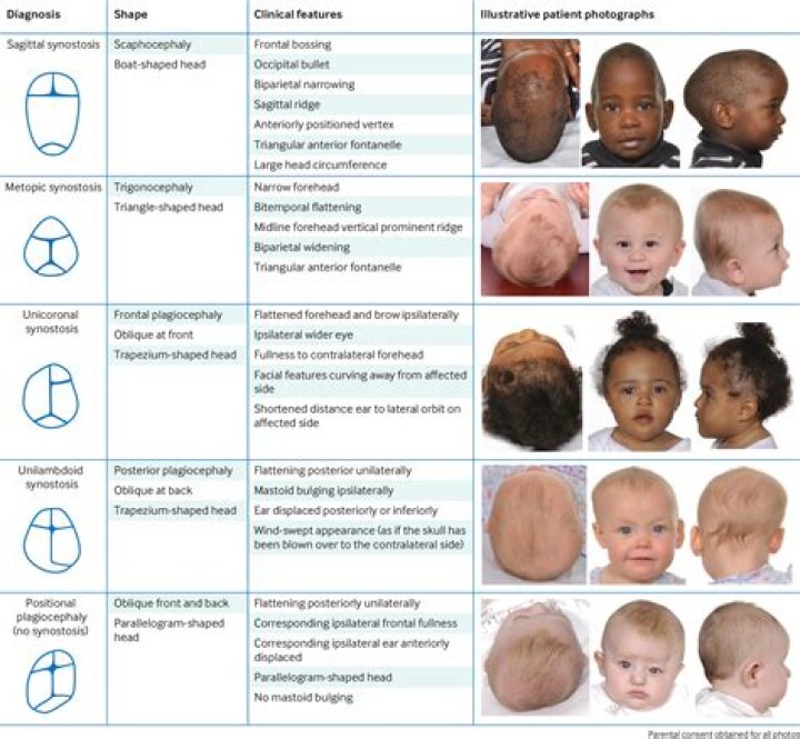 Does craniosynostosis get worse with age?