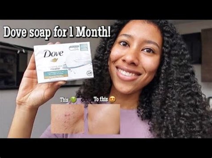Does Dove soap cause pimples?