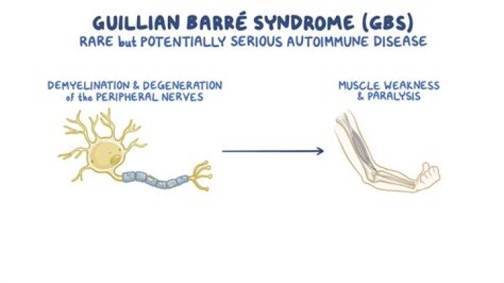 Does Guillain-Barré shorten your life?