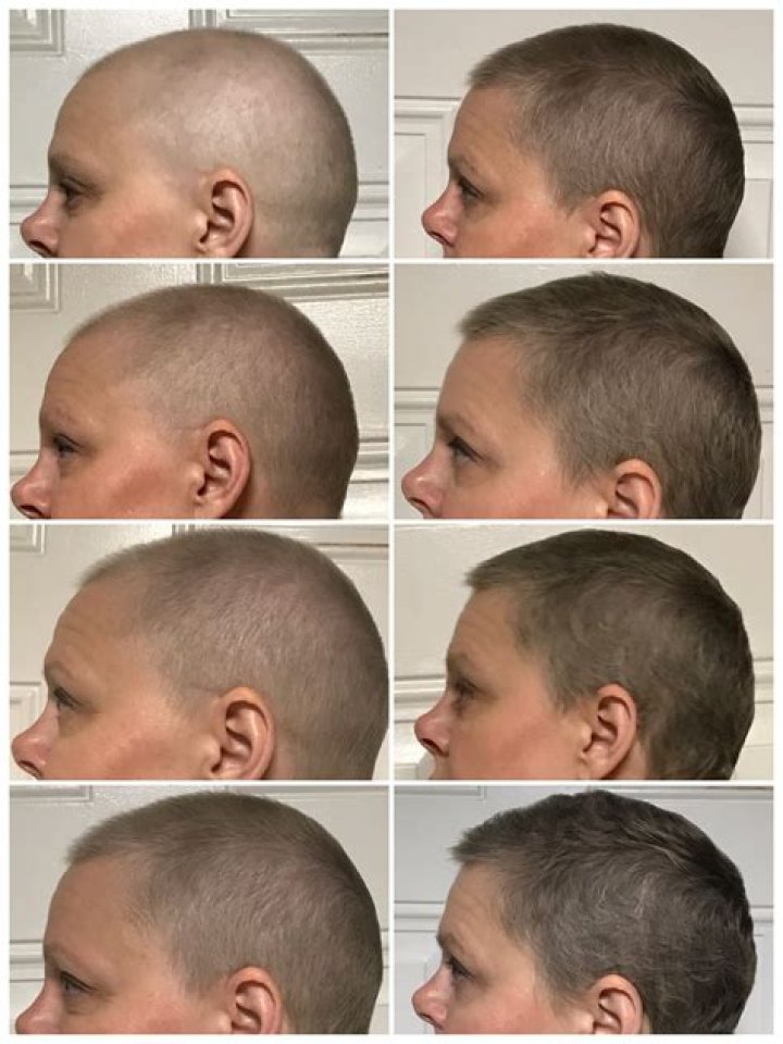 Does hair grow back GREY after chemo?