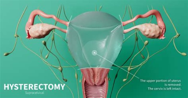 Does having a hysterectomy cure endometriosis?