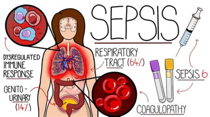Does having sepsis once make you more likely to get it again?