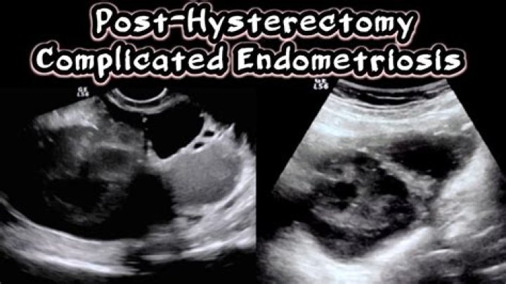 Does hysterectomy cure endometriosis?