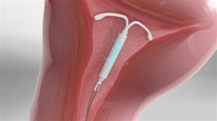 Does IUD cause anxiety?