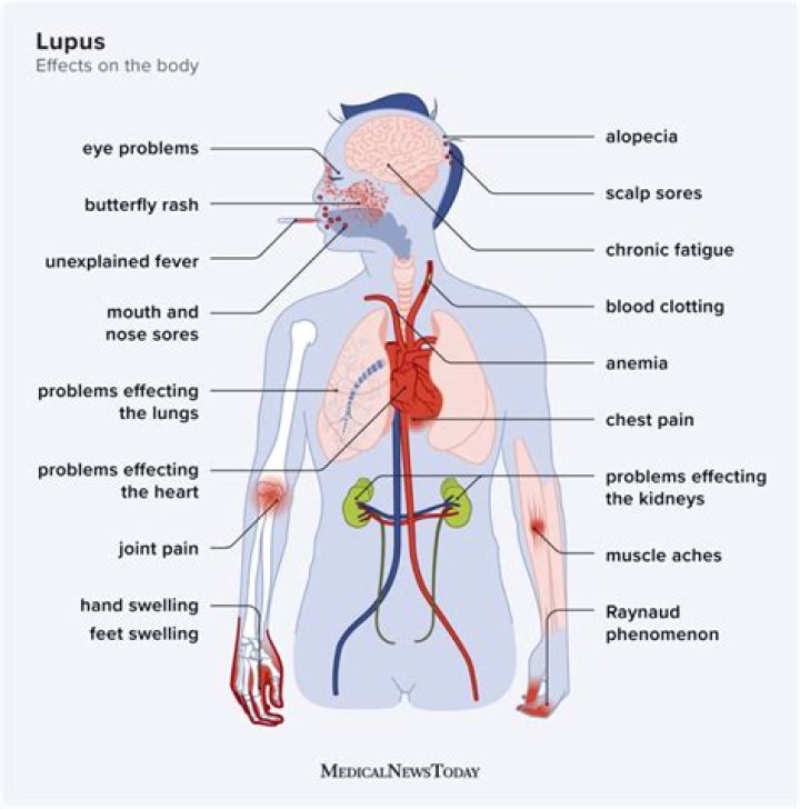 Does lupus make you sweat a lot?