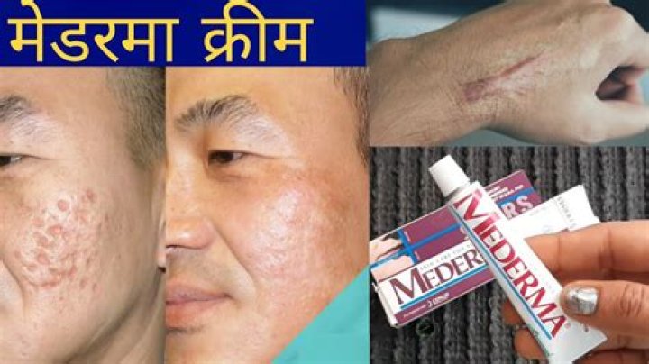 Does Mederma work on old scars?
