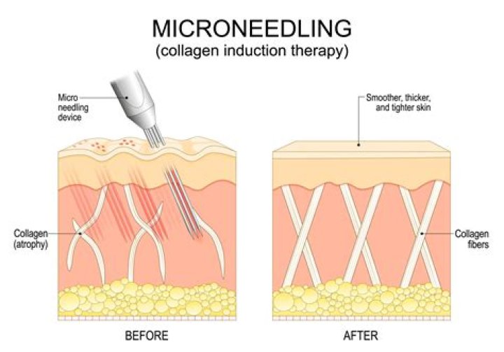 Does microneedling help with scar tissue?