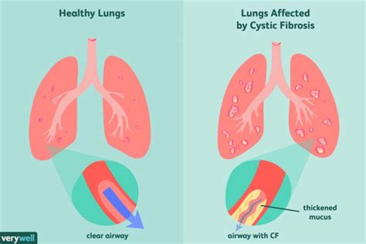 Does new lungs cure cystic fibrosis?
