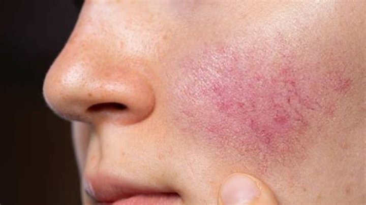 Does red wine cause wrinkles?