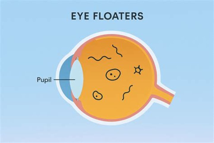Does Rubbing eyes cause floaters?