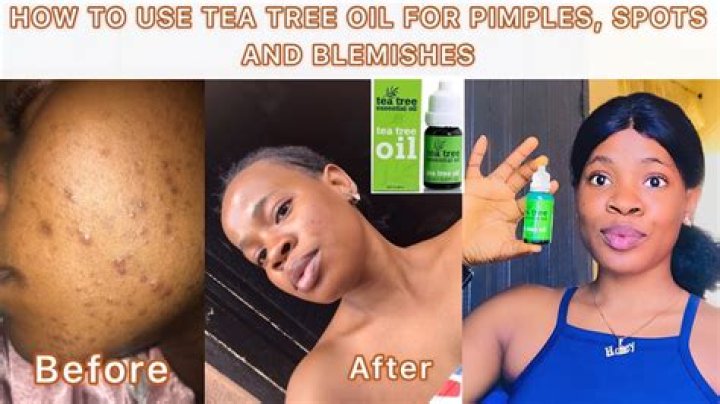 Does tea tree oil remove acne?