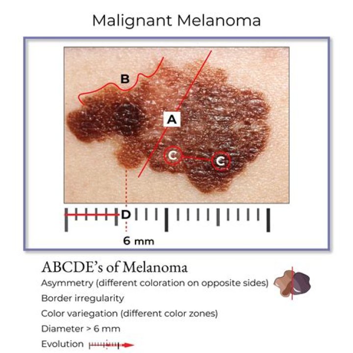 Does the size of melanoma matter?