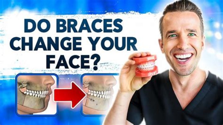 Does your face shape change after braces?