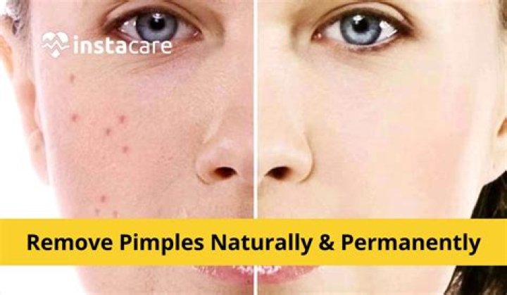 How can I clear pimples?