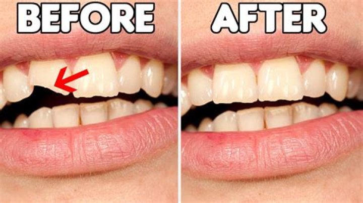 How can I fix my teeth naturally?