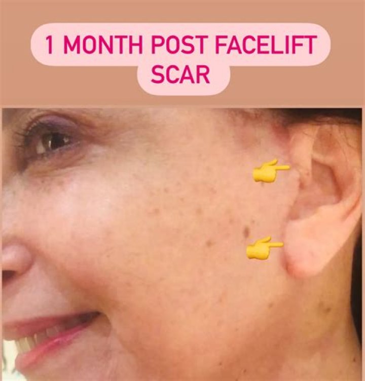 How can I make my facelift last longer?