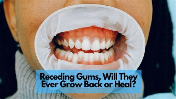 How can I regrow my receding gums naturally?