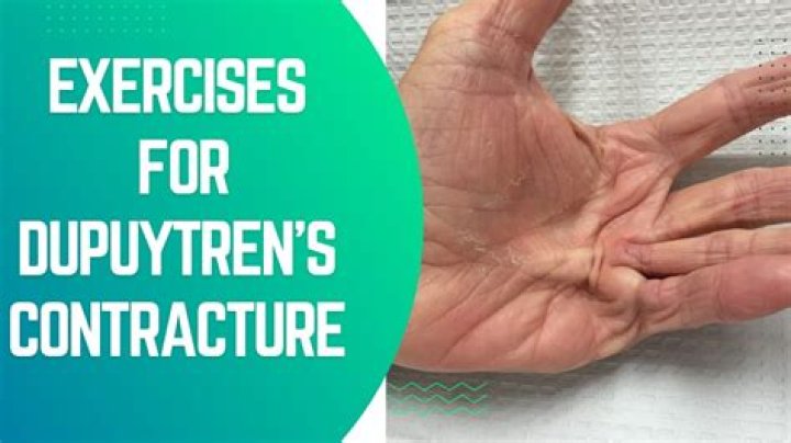 How can you prevent Dupuytren's?