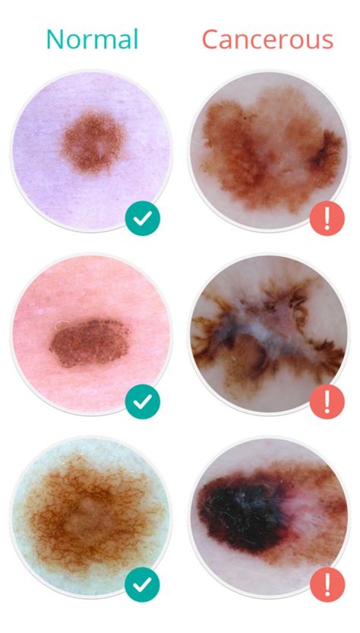 How can you tell if a mole is cancerous?