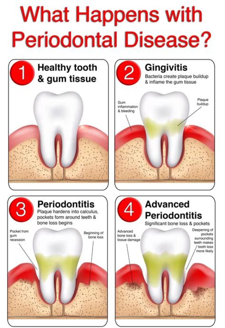 How can you tell the difference between periodontitis and gingivitis?