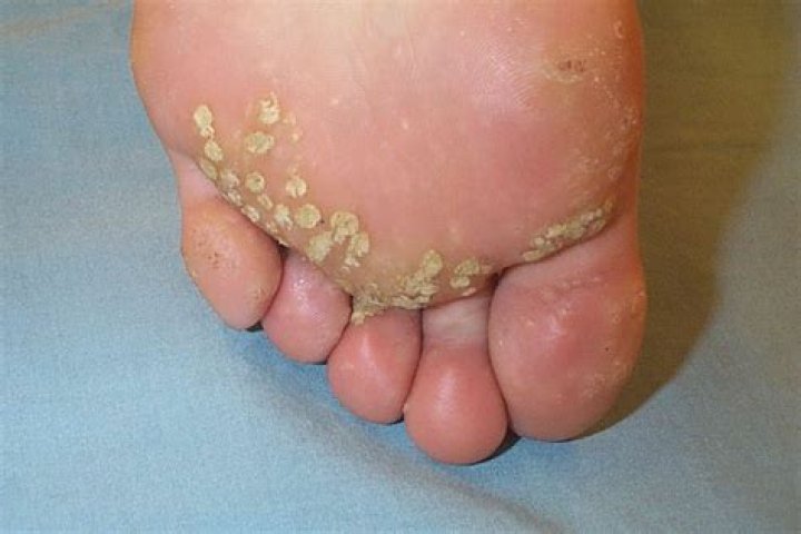 How deep is a plantar wart?