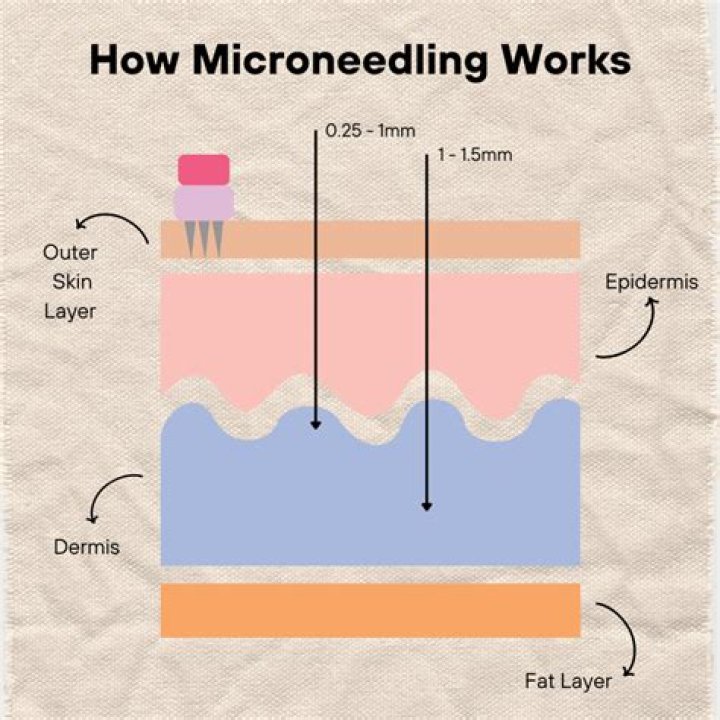How deep should you go with microneedling?